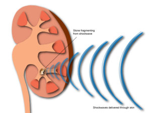 eswl-diagram-600